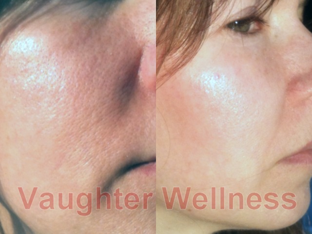 cheek-before-after-dermarolling cheek before and after dermarolling