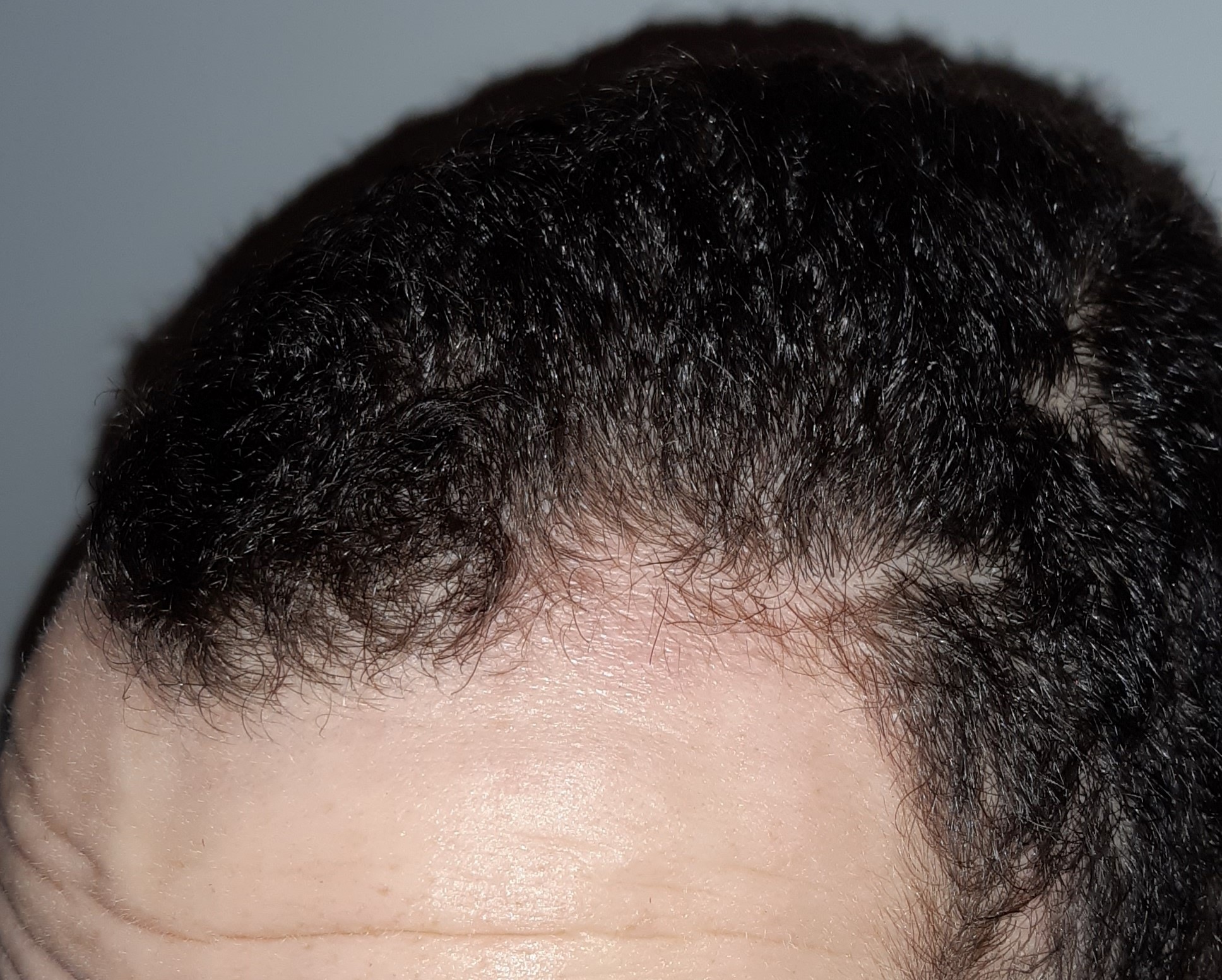 Alopecia dermaneedling with the Derminator - before and after