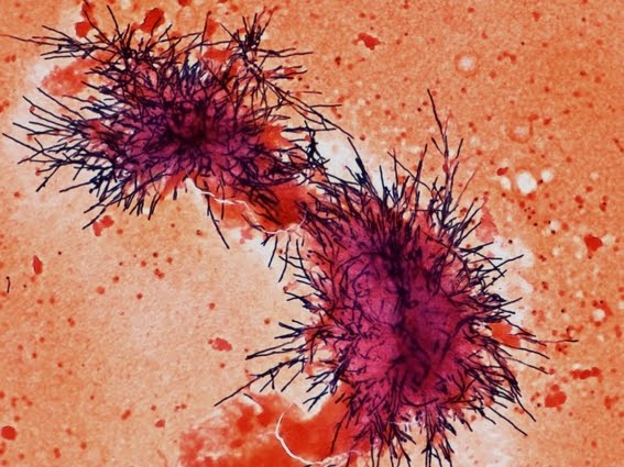 Candida albicans in direct smear of Positive Blood Culture.