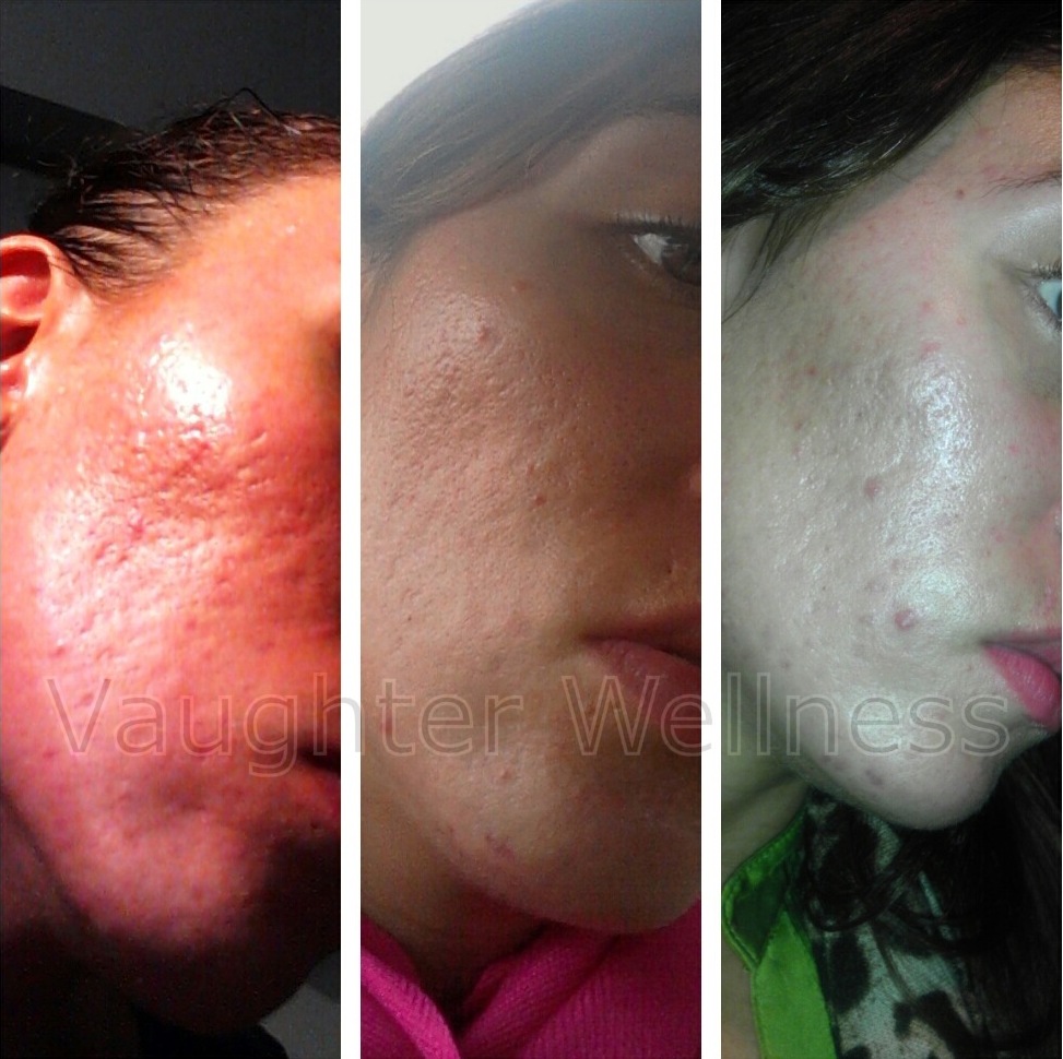 acne scars before and after dermaneedling