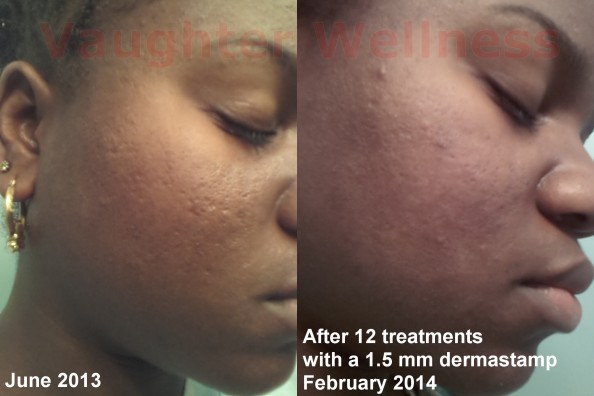 facial scars on dark skin dermarolling before and after photo