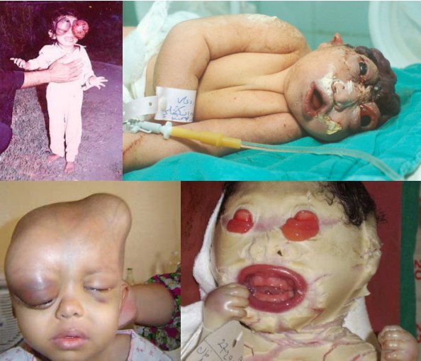 depleted-uranium-children