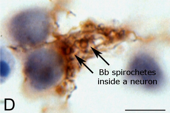 Borrelia-Bb-spirochetes-inside-neuron
