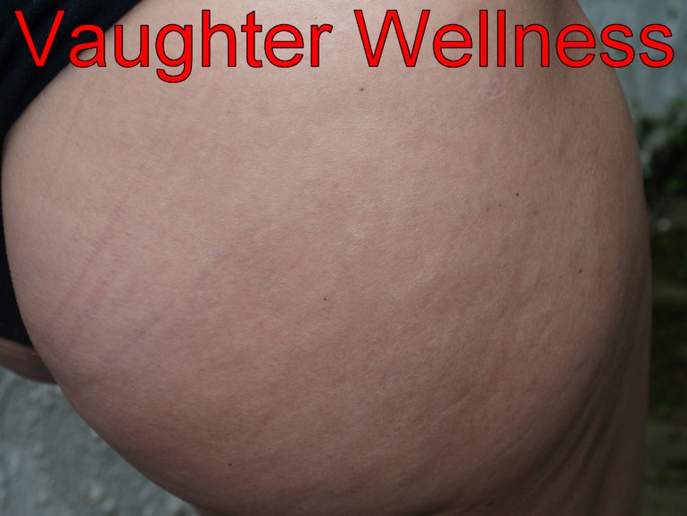 Stretchmarks after single needle